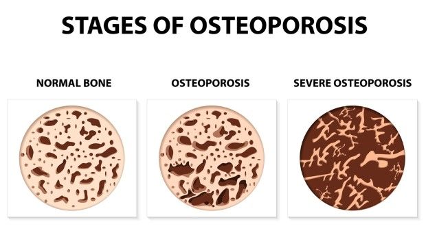 combatir la osteoporosis en los huesos