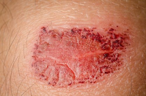 Lesiones precancerosas de la piel - Enfermedad de Bowen