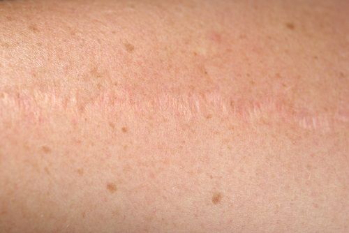 Lesiones precancerosas de la piel - Lentigo solar o senil