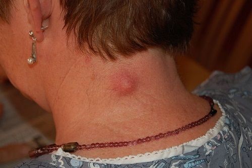 Lesiones precancerosas de la piel - Nevus sebácea